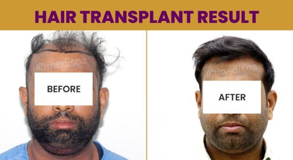 Is Hair Restoration The Most Ideal Solution For Pattern Baldness?