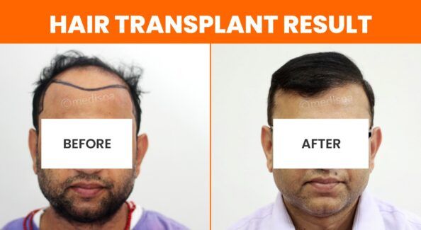 How To Avoid The Side Effects After Hair Transplant Surgery?