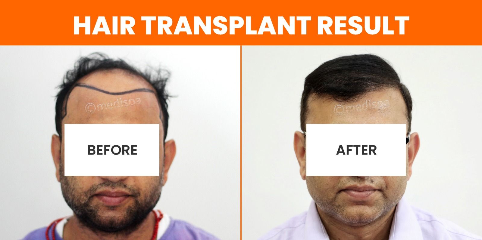 How To Avoid The Side Effects After Hair Transplant Surgery?