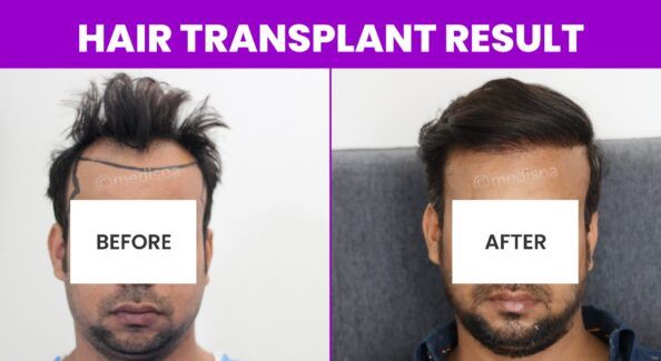 From Baldness To Fullness: The Scientific Principles Of Hair Transplantation