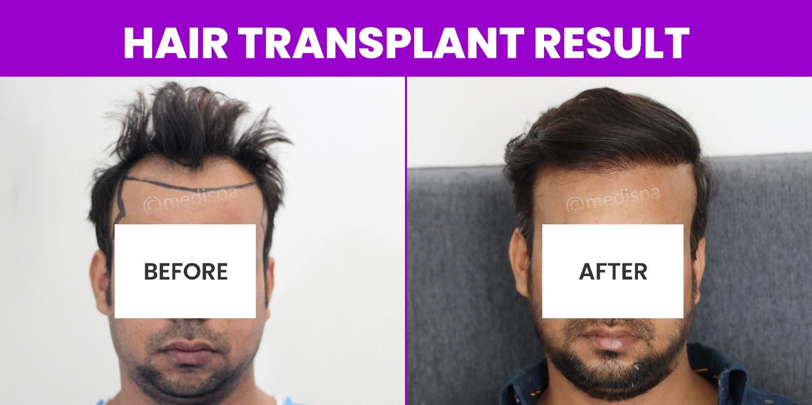 From Baldness To Fullness: The Scientific Principles Of Hair Transplantation