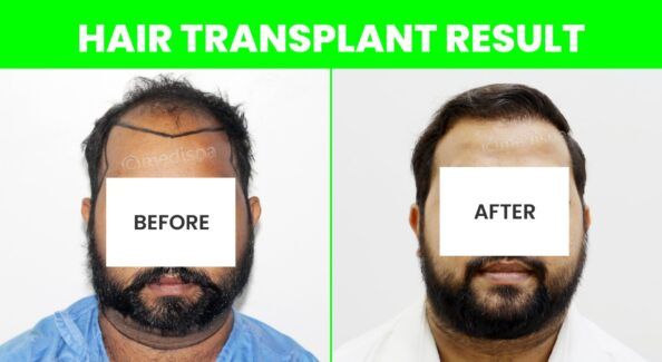 Best Ways To Get Ideal Hair Transplant Treatment