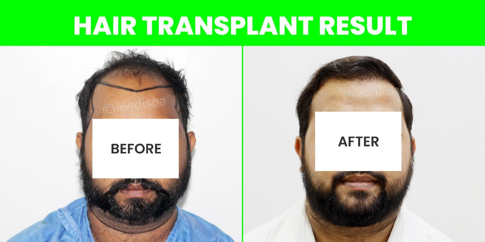 Best Ways To Get Ideal Hair Transplant Treatment
