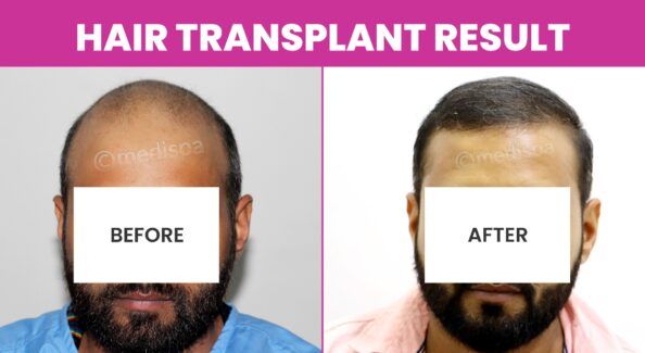 Preparing For Hair Restoration: What To Expect?