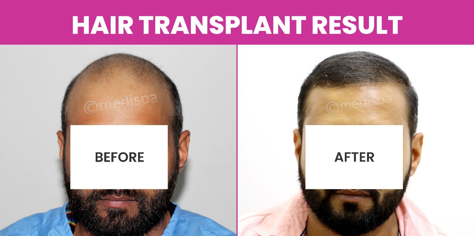 Preparing For Hair Restoration: What To Expect?