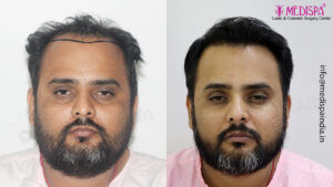 Hair Transplant in Delhi