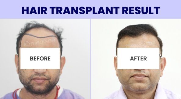 What Defines A Successful Outcome In Hair Transplantation?