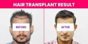 What Techniques Can Be Used To Optimize Hair Density Through Hair Restoration?