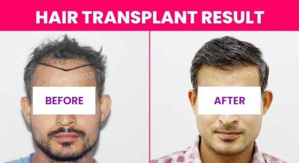 What Techniques Can Be Used To Optimize Hair Density Through Hair Restoration?