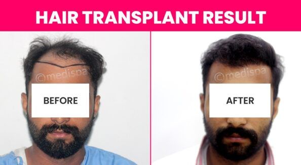 Is It Possible To Cure Alopecia Areata By Hair Transplant?