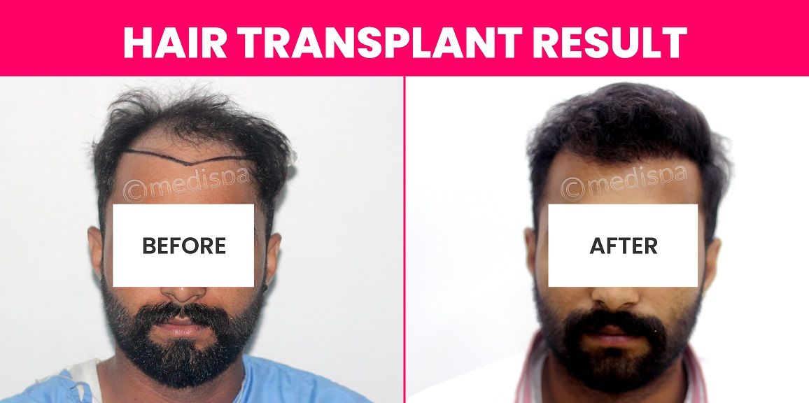 Is It Possible To Cure Alopecia Areata By Hair Transplant?
