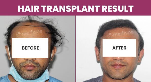 Can Hair Restoration Successfully Address Genetic Hair Loss?