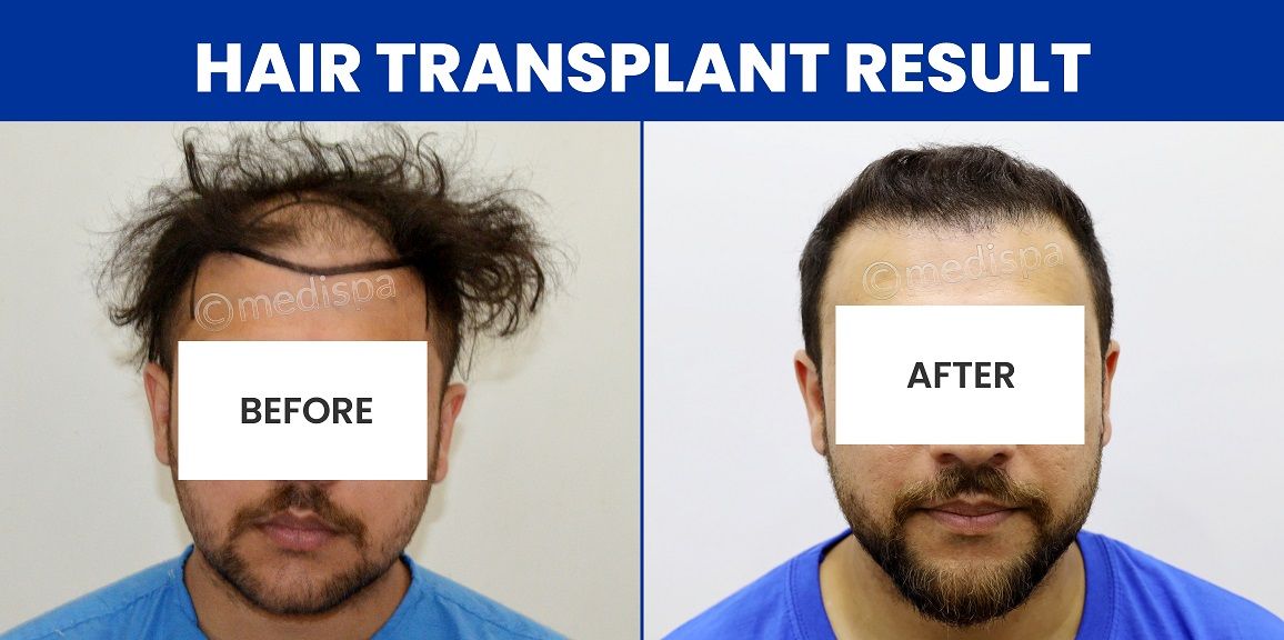 What Is The Success Rate of Hair Transplantation In Addressing Hair Loss?
