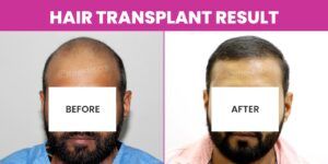 How Is The Effectiveness Of A Hair Transplant Procedure Measured?