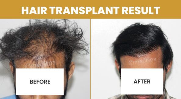 Is Hair Transplantation A Reliable Treatment For Baldness?