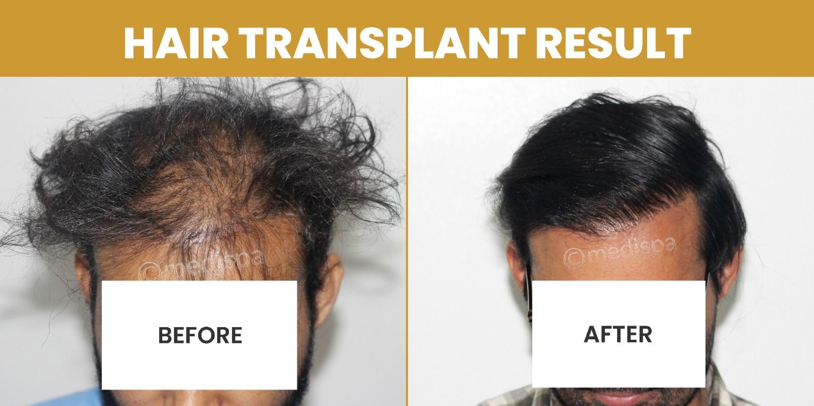 Is Hair Transplantation A Reliable Treatment For Baldness?
