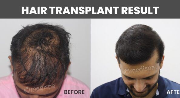 Ensuring A Safe And Successful Hair Transplant: Expert Tips