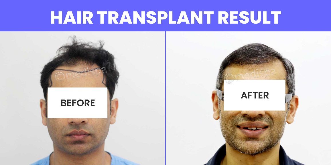 Achieve A Natural Look: Get A Realistic Hairline With Hair Transplant