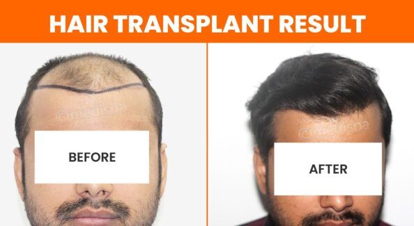Measuring The Success Of Hair Transplantation: What To Expect