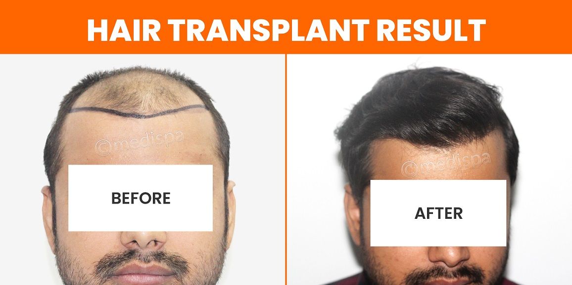 Measuring The Success Of Hair Transplantation: What To Expect
