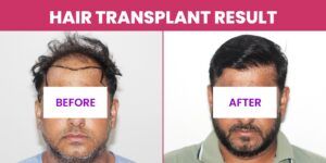 Trust Your Hair To The Best: Benefits Of Choosing An Experienced Hair Transplant Surgeon