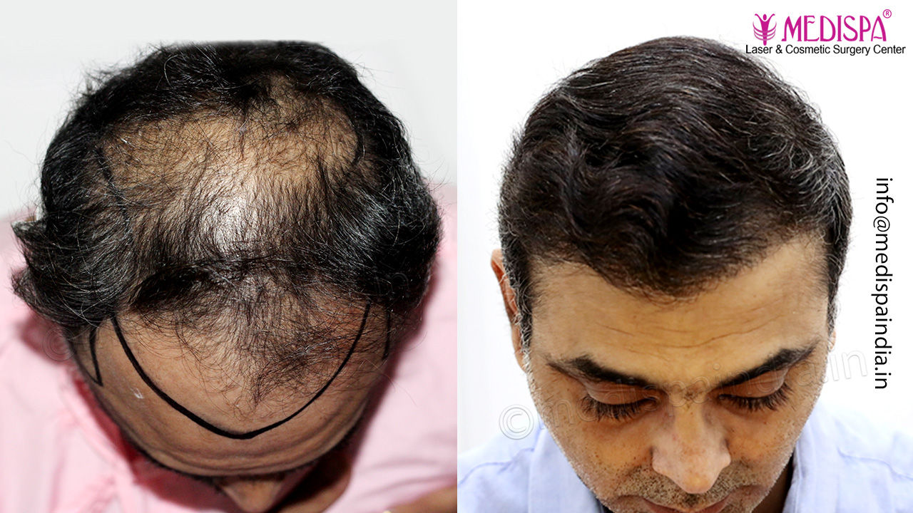 best hair transplant result india delhi