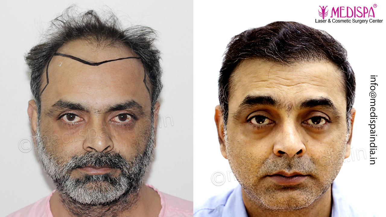 hair transplant bangalore