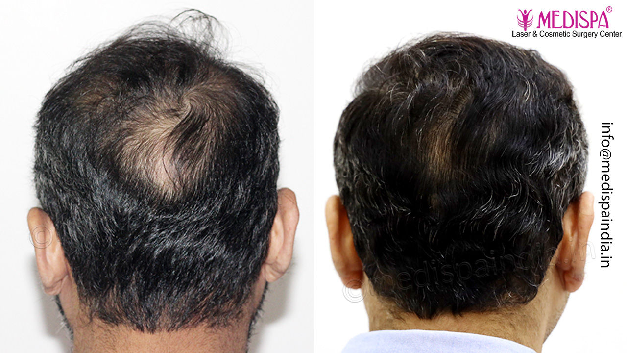 best hair transplant result london