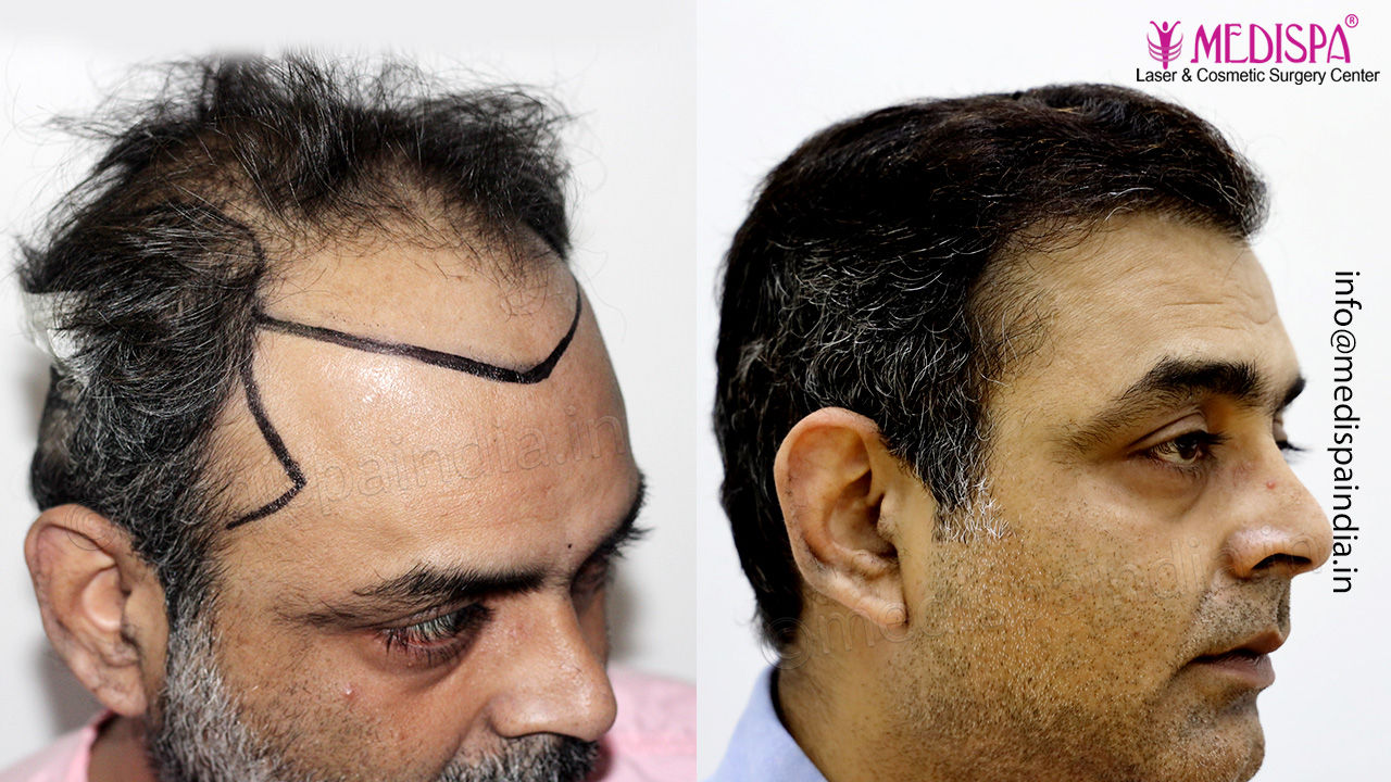 best hair transplant result usa