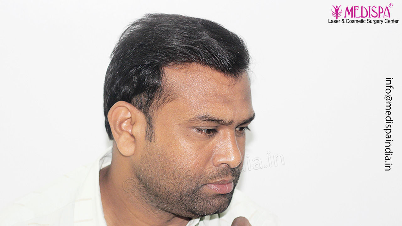 hair transplant results jaipur