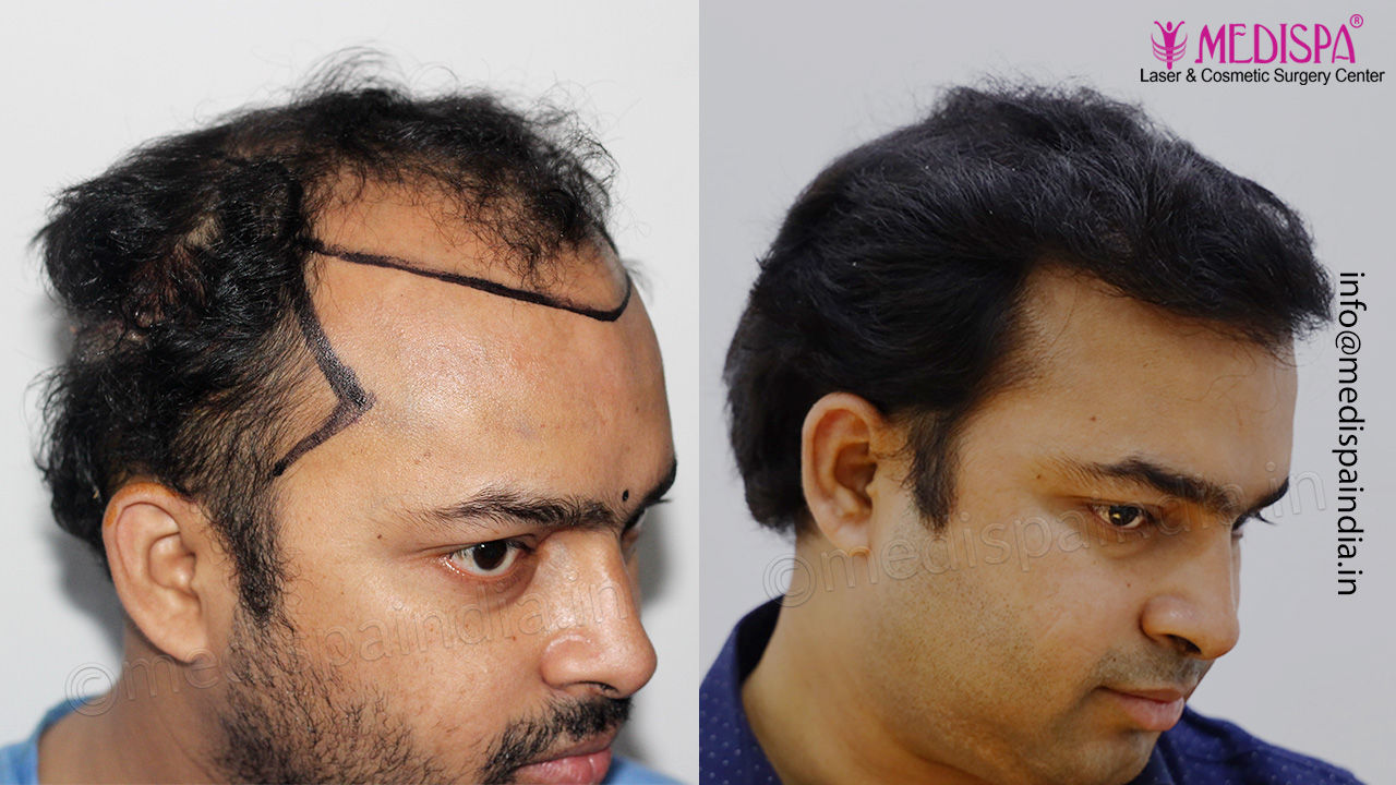 top hair transplant clinic results delhi