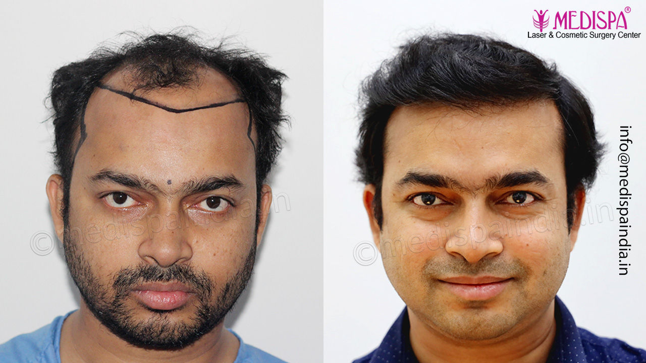 hair transplant chennai, india