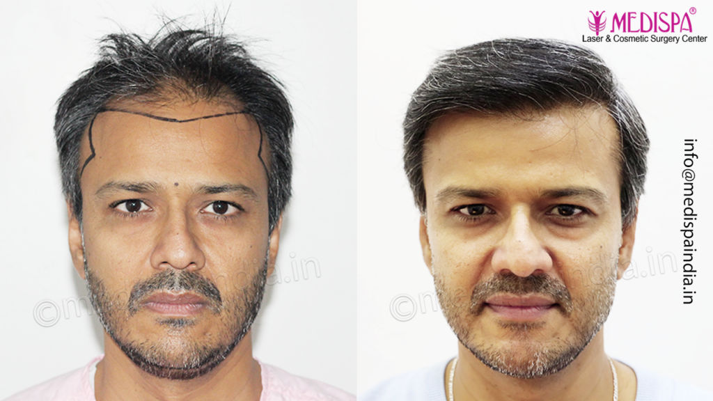 hair transplant india
