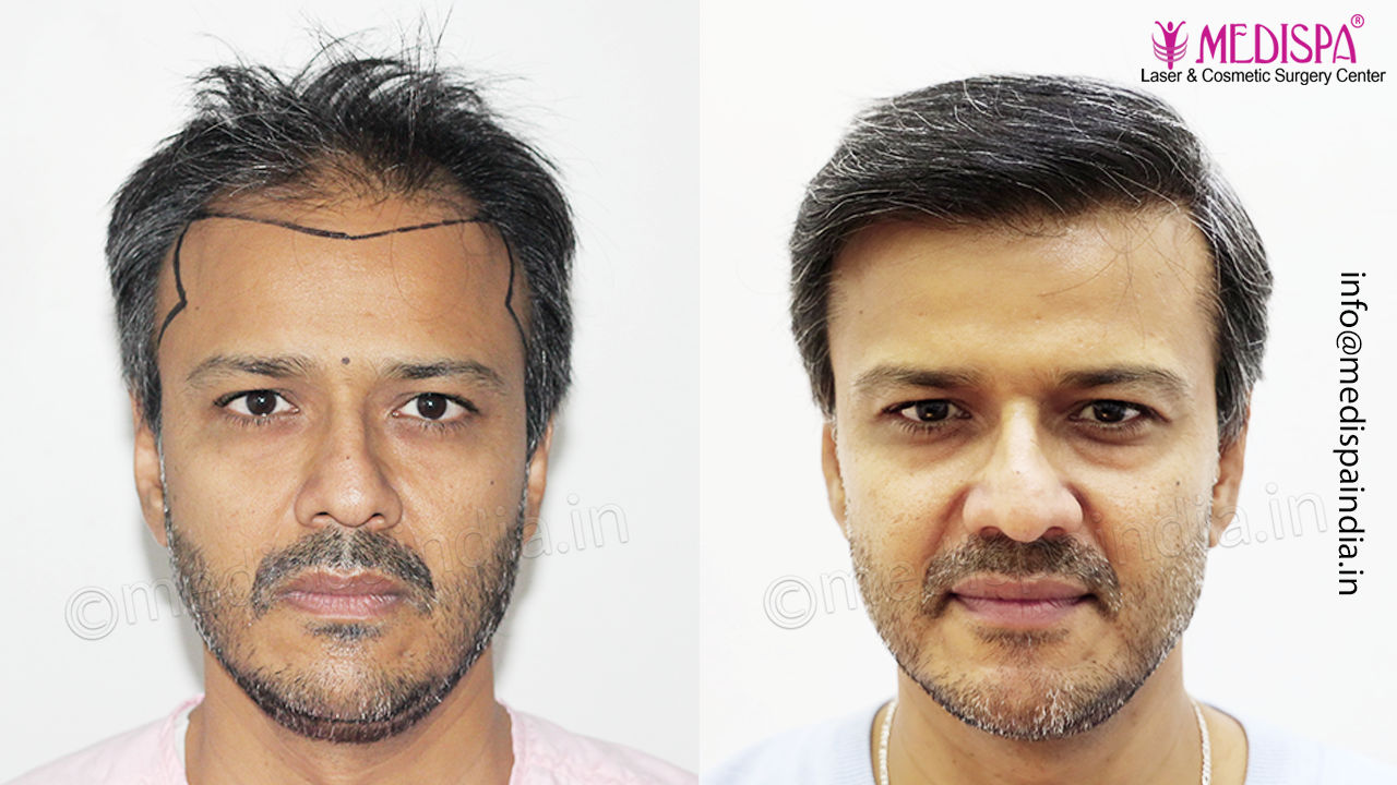 hair transplant india