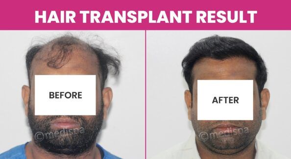 Understanding Baldness: Stages, Causes, And How Hair Transplant Can Help