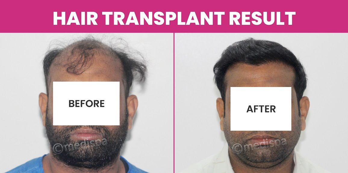 Understanding Baldness: Stages, Causes, And How Hair Transplant Can Help