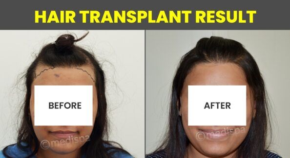 Restoring Confidence: The Complete Guide To Female Hair Transplant