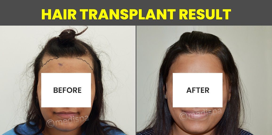 Restoring Confidence: The Complete Guide To Female Hair Transplant