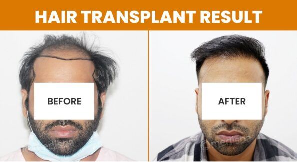 The Right Time For A Fuller Head: When To Consider Hair Restoration