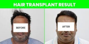 Key Things To Know About Hair Transplant Surgery