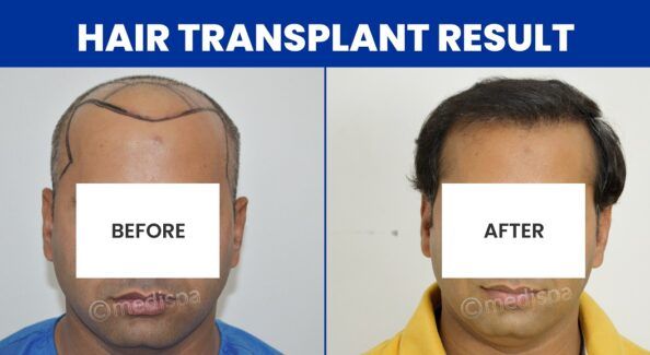 Post-Hair Transplant Precautions: Reducing The Risk Of Complications