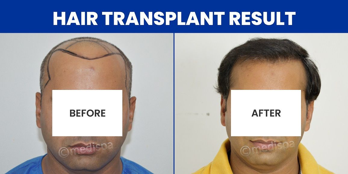 Post-Hair Transplant Precautions: Reducing The Risk Of Complications