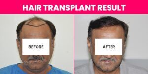 Thinning Hair? Exploring The Effectiveness Of Hair Transplantation
