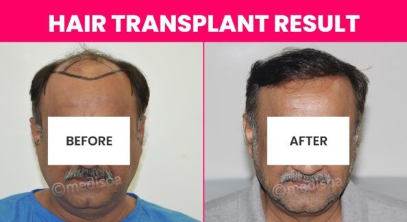 Thinning Hair? Exploring The Effectiveness Of Hair Transplantation