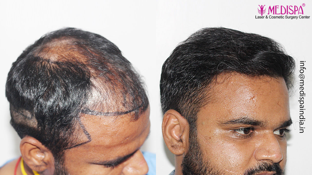 best hair restoration center results in hyderabad