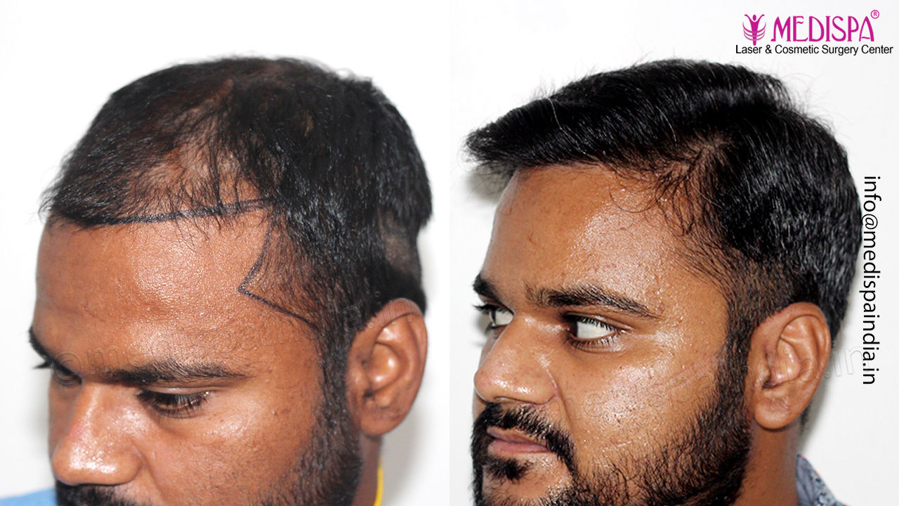 best hair restoration clinic results in hyderabad