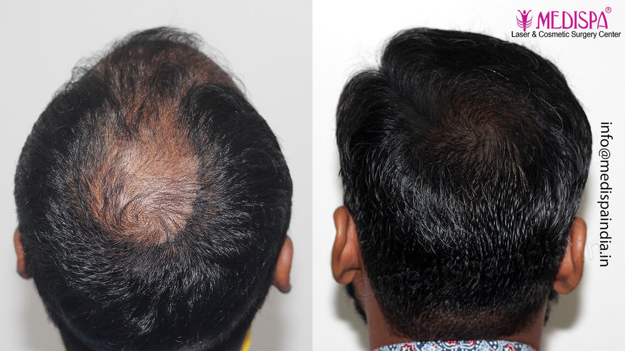 best hair restoration result in hyderabad
