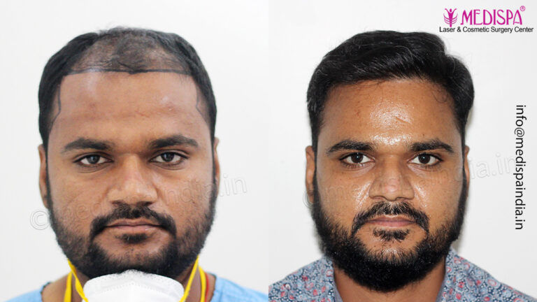 Jaipur hair transplant result