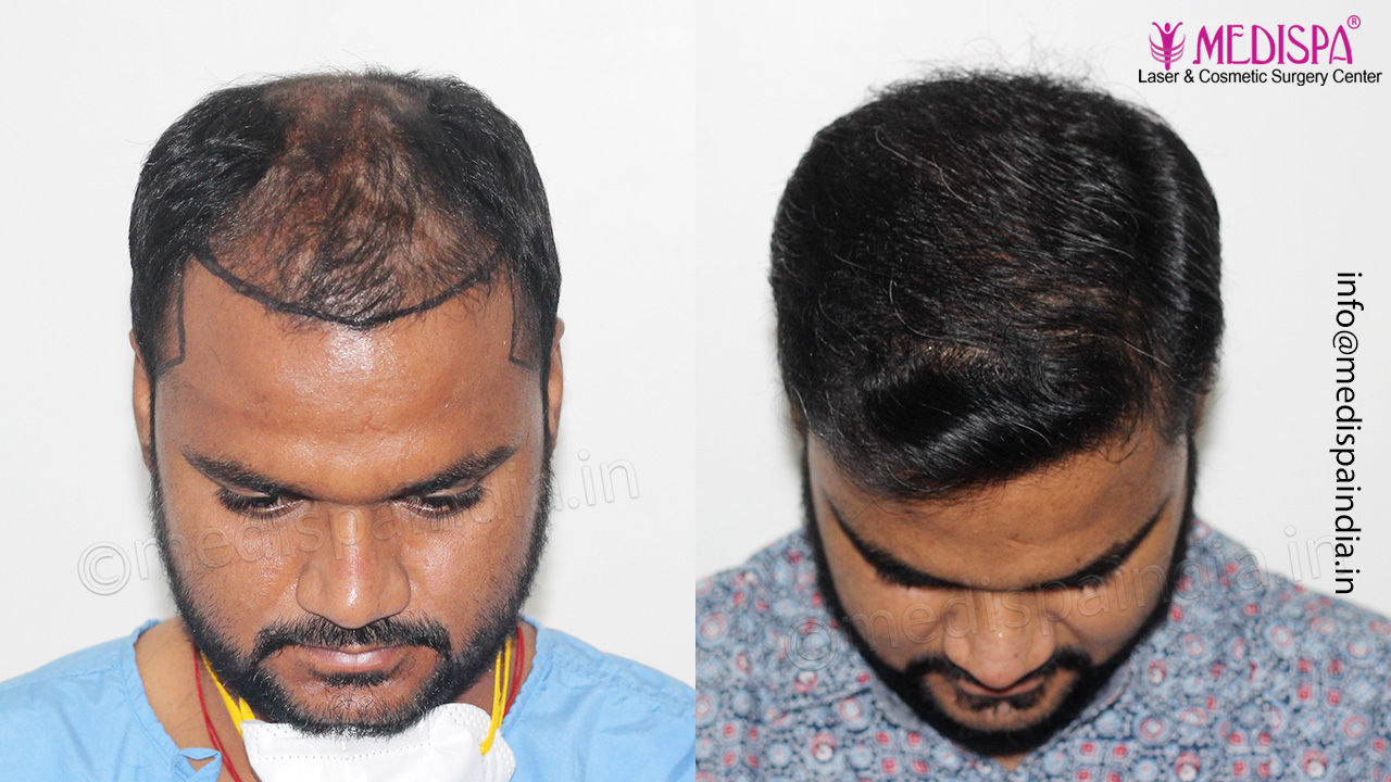 best hair restoration surgeon results in hyderabad