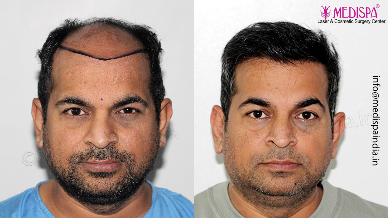 Gurgaon hair transplant result